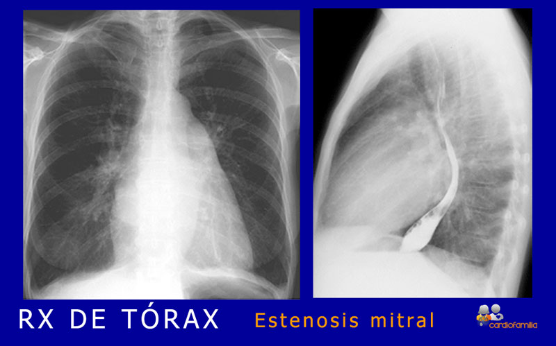 RX Tórax - Se aprecia crecimiento de la aurícula izquierda, que se manifiesta como un aumento de la densidad que levanta el bronquio izquierdo y origina un doble contorno en la parte baja del borde derecho de la silueta cardiaca. El crecimiento de la orejuela izquierda se manifiesta como un arco prominente por debajo del de la arteria pulmonar en el borde izquierdo de la silueta. En la placa lateral se puede apreciar cómo la aurícula crece hacia atrás y el ventrículo derecho ocupa al menos la mitad del espacio retroesternal. RX_torax_estenosis_mitral_x580_www.cardiofamilia.org