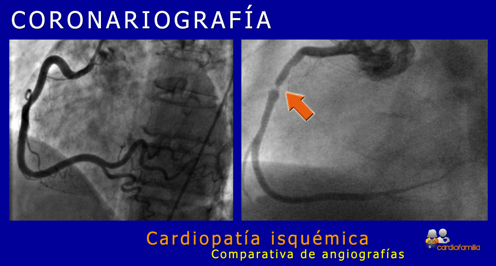 Coronariografía: angiografía de una arteria coronaria derecha normal (a la izquierda) y de una arteria coronaria derecha en un paciente con una obstrucción coronaria severa en su tercio medio (a la derecha, indicado con flecha) coronariografia x580 www.cardiofamilia.org