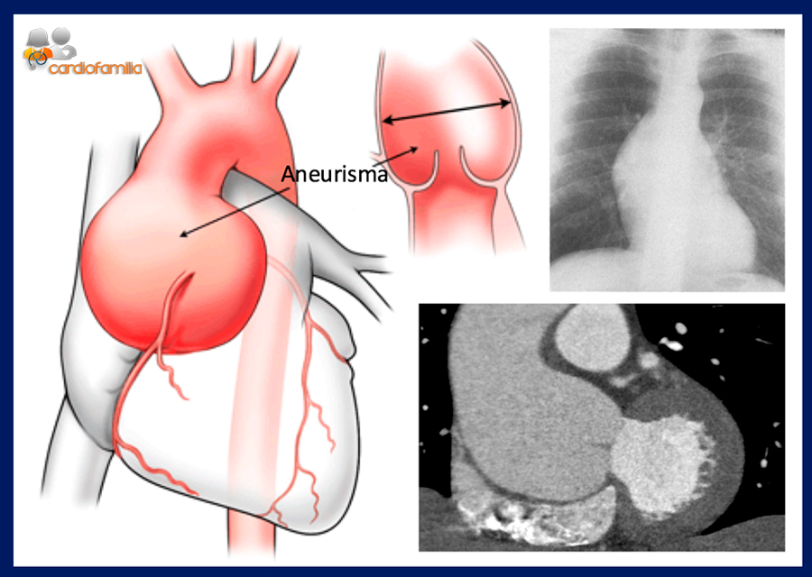 Dilatación de la raíz aórtica :: La dilatación de la raíz aórtica (anuloectasia aórtica primaria o secundaria, por ejemplo, a aneurisma, como en este caso, o a hipertensión arterial) puede hacer que las valvas aórticas sean incapaces de cerrar un anillo aórtico dilatado, originando así una insuficiencia aórtica. Derecha arriba, Rx de tórax; abajo, TAC. dilatacion raiz aortica cardiofamilia