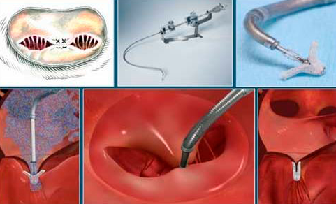 Técnica Mitra Clip manejo insuficiencia mitral