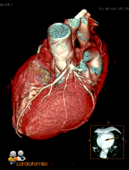 Tomografía computerizada multicorte tomografia computerizada multicorte cardiofamilia