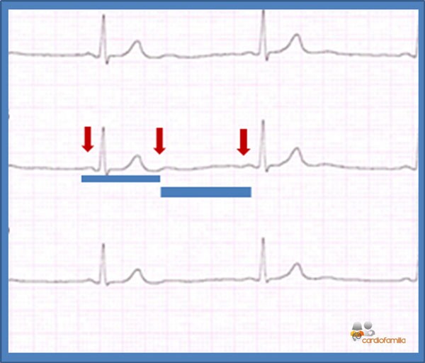 ECG 12 mayo resp
