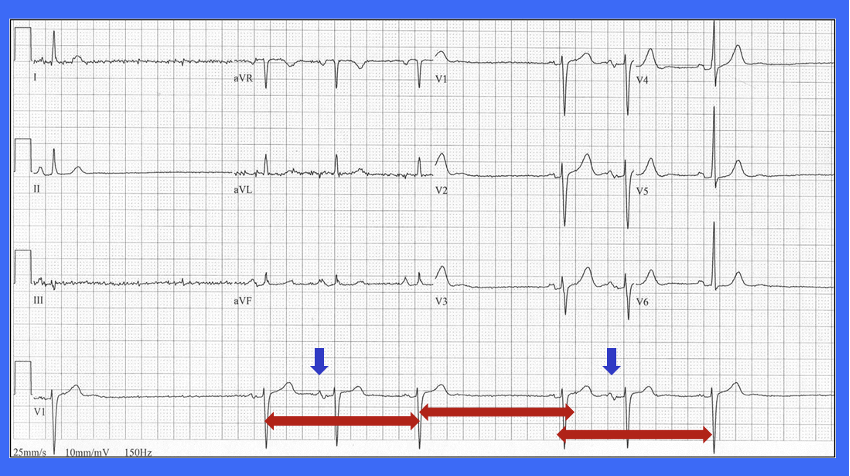 ECG respuesta sugestivo disfuncion nodulo sinusal