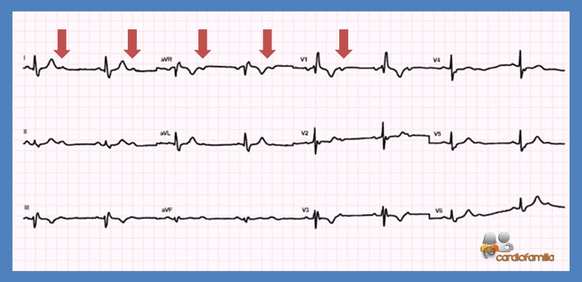 ECG14 Cardiologia mayo resp