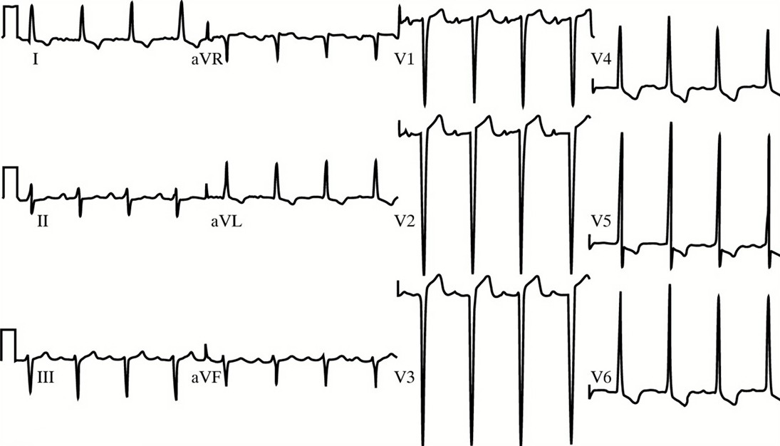 ECG 15 2018 CVI2 cardiofamilia