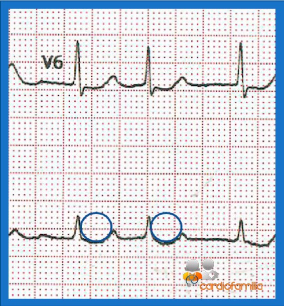ECG 1_1