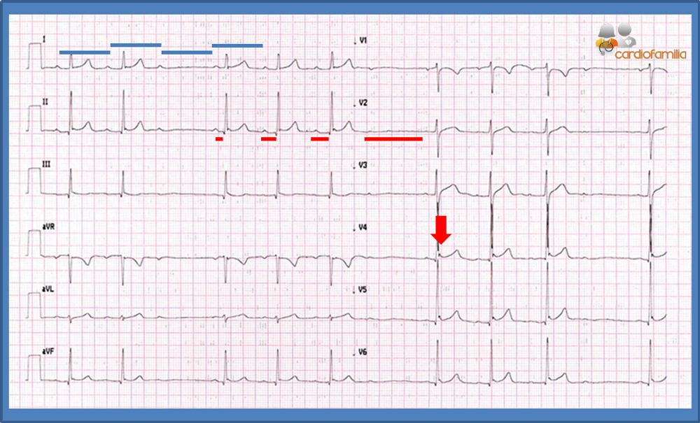 ECG cardiofamilia 23.01.2017 result