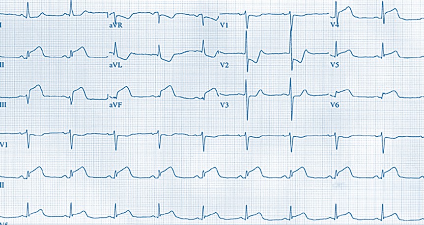 ECG enero 2019 cardiofamilia