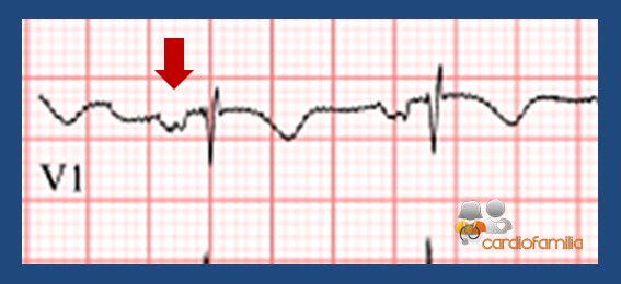 EM CAI CVD 1 2 cardiofamilia