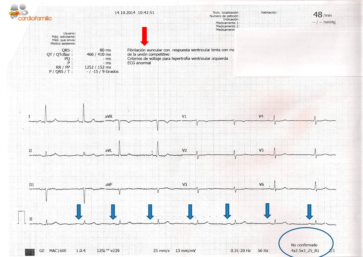 cardiofamilia ecg fa fal2