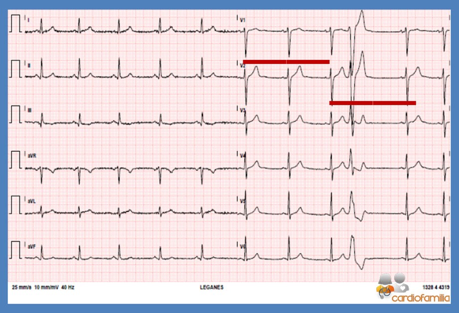 ecg25 05 2021