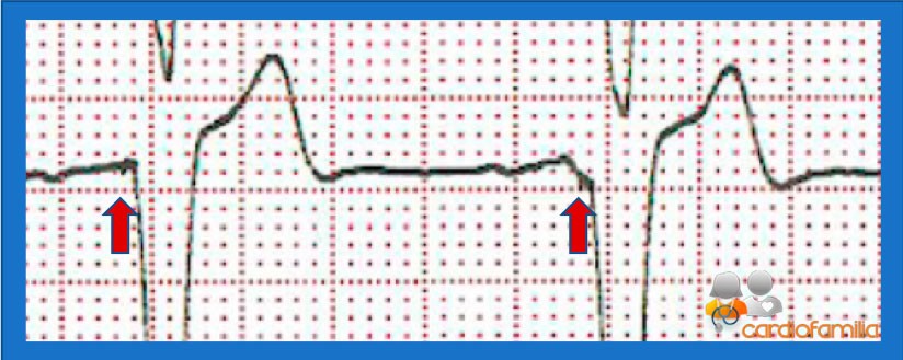 ECG 4.1