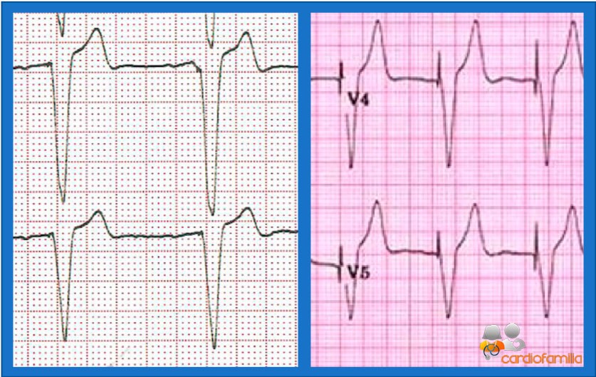 ECG 4.2