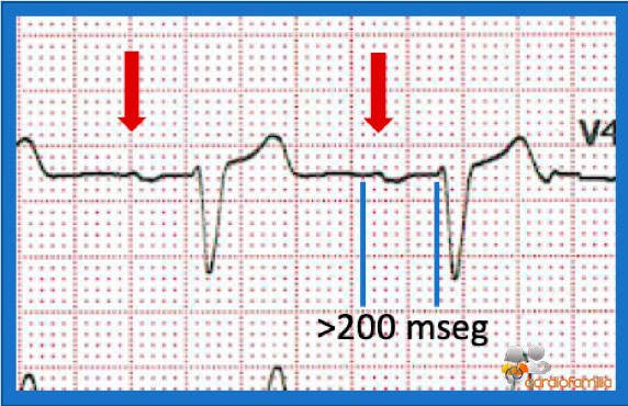 ECG 5.1