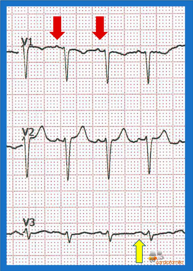 ecg71