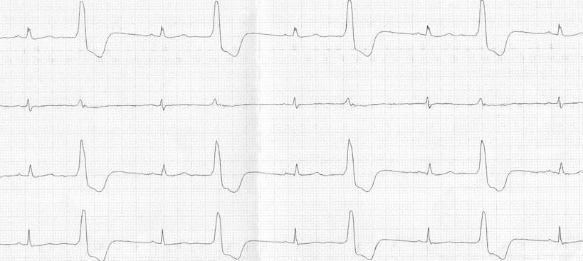 Paciente con insuficiencia cardíaca en tratamiento con un IECA, digoxina y diuréticos. Acude quejándose de náuseas, anorexia y debilidad. El ECG es el que se muestra. ¿Qué actitud entre las siguientes es la más adecuada?