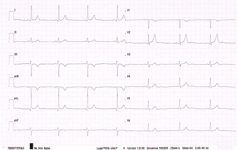 Analice el siguiente ECG, obtenido de un varón joven