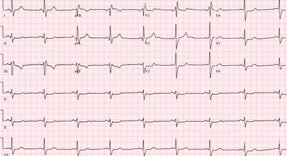 El paciente al que pertenece el siguiente ECG se queja de pérdidas de conciencia. ¿Cuál puede ser la causa?