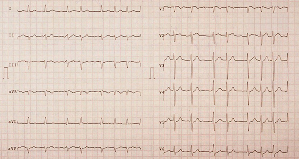 Paciente con antecedentes de insuficiencia cardíaca, en tratamiento con diuréticos, IECAs y betabloqueantes, que acude a urgencias por decompensación. ¿Cuál puede ser el factor desencadenante?
