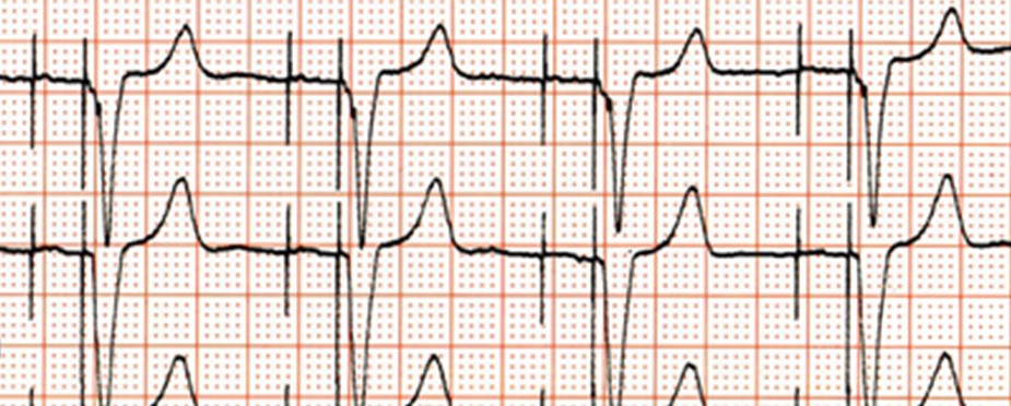 ¿Qué le parece que tiene el paciente al que pertenece el siguiente ECG?