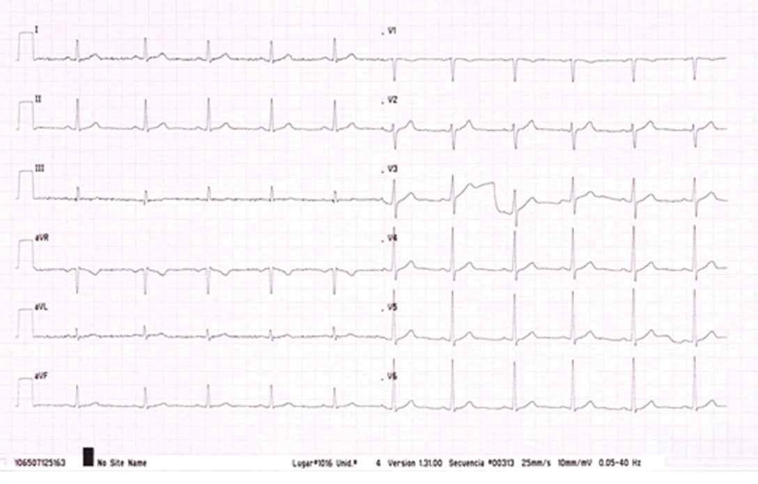 El siguiente ECG, tomado de un reconocimiento de rutina, le parece alarmante porque...