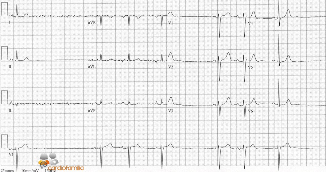 Este ECG de un paciente que se queja de síncopes. ¿Qué opina?