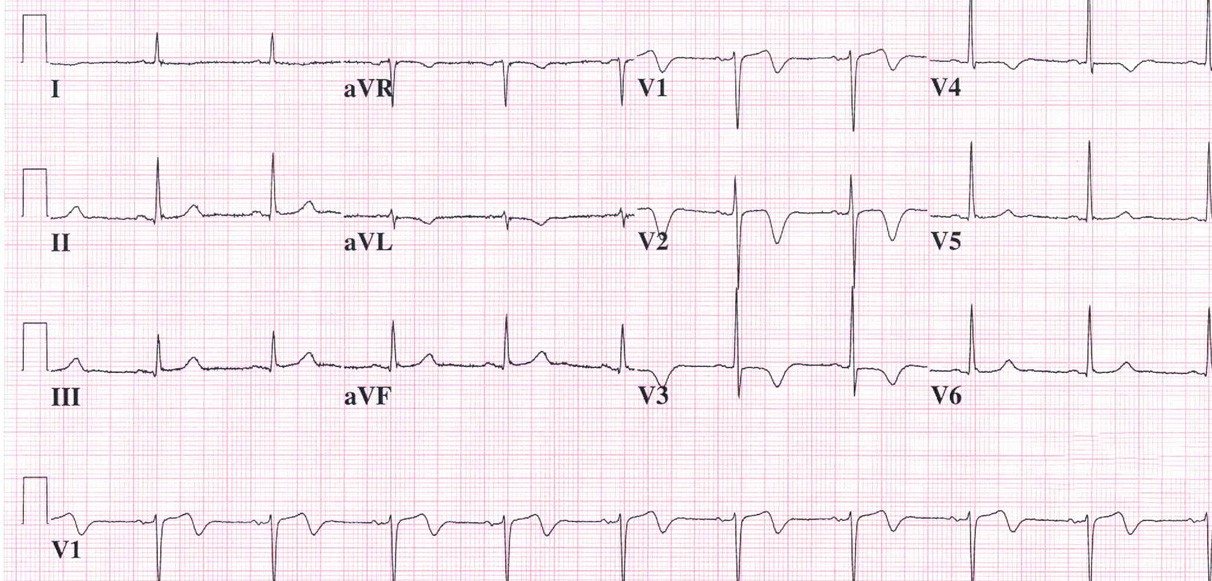 Paciente de 62 años que acude a Urgencias que acude de un dolor opresivo precordial que le ha durado quince minutos. El ECG, ya, sin dolor, es el siguiente. ¿Qué le parece?