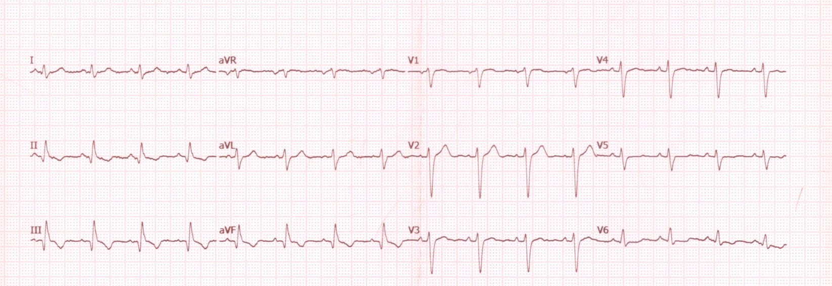 Al paciente al que pertenece este ECG se le ausculta un soplo sistólico en axila. ¿Se le ocurre qué podría producirlo?