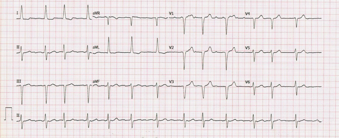 Fernando, de 65 años, padeció hace tiempo un infarto de miocardio anteroseptal y está tomando enalapril y bisoprolol. Acude quejándose de palpitaciones ¿Cuál cree que es la causa a la vista de su ECG?