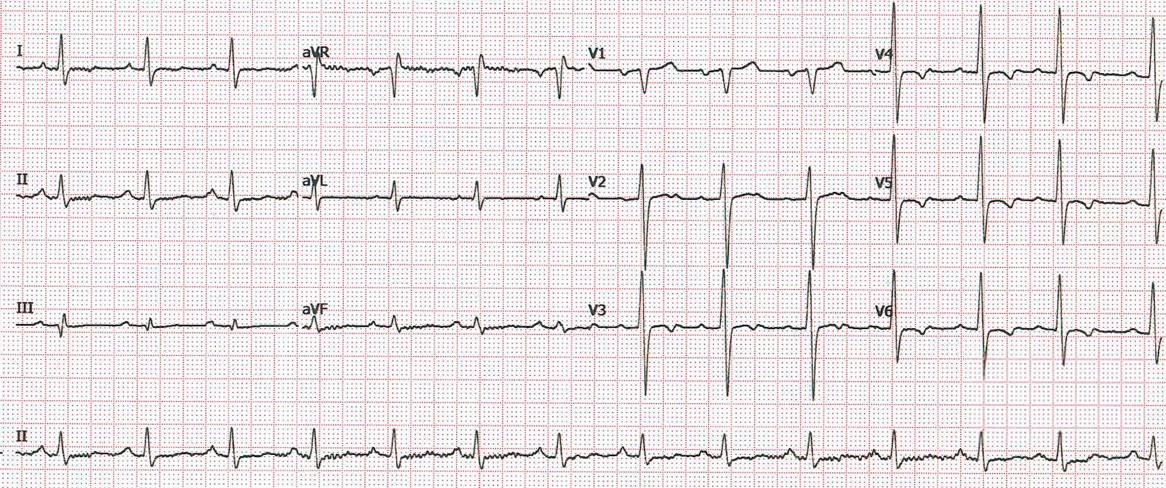 Juan acude a Urgencias refiriendo que ha tenido un dolor torácico de 20 minutos de duración, que ha cedido espontáneamente. A la vista del ECG, Vd. Sospecha que: