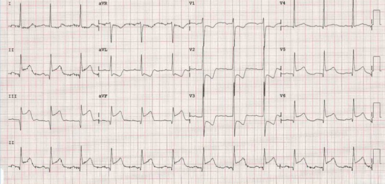 Este es el ECG de un paciente que acude a urgencias por dolor torácico de media hora de evolución. ¿Dónde le parece que está el problema?