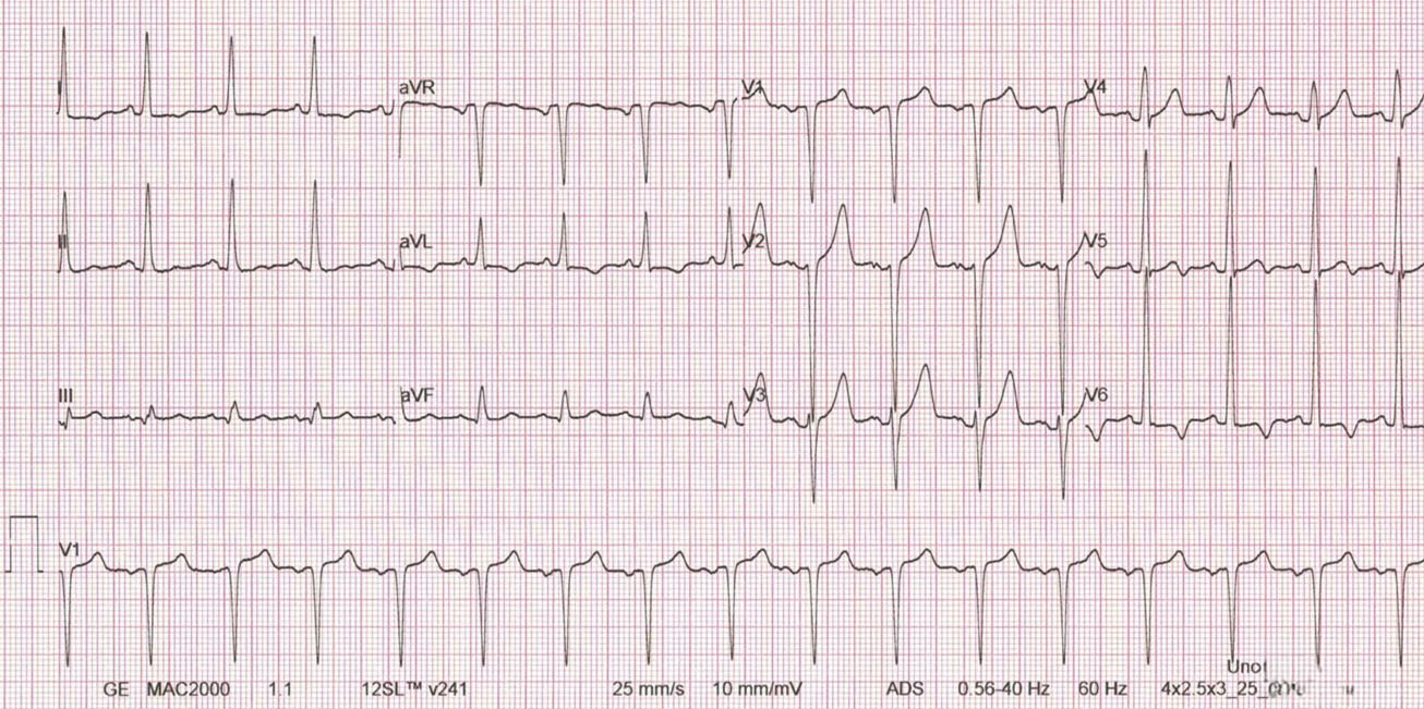 El siguiente ECG pertenece a un joven de 34 años asintomático. ¿Qué le parece?