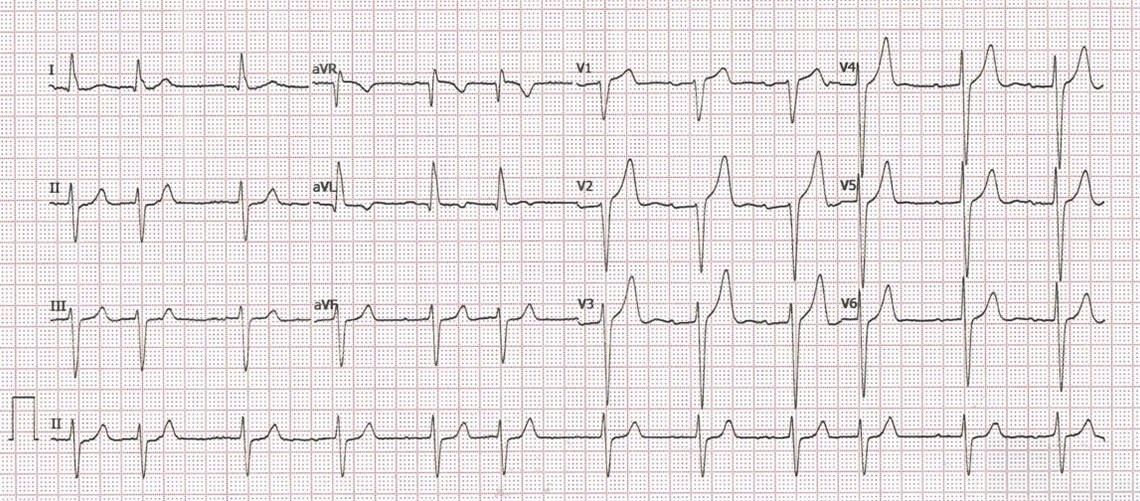¿Qué ritmo tiene este ECG?