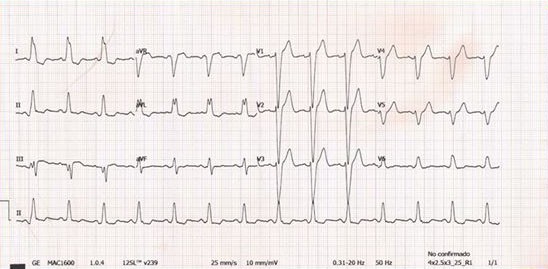 Paciente de 32 años con insuficiencia cardiaca debida a una miocardiopatía dilatada. Se encuentra muy sintomático pese a tratamiento médico habitual. El ECG es el que se puede ver en la imágen, el ecocardiograma muestra una fracción de eyección del VI del