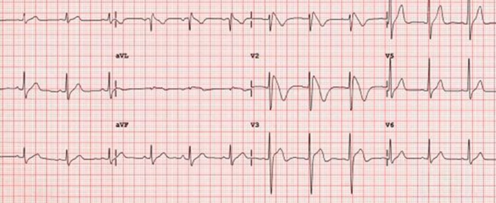 El camarero del restaurante tailandés al que Vd. ha ido a cenar con su novia, al enterarse de que es cardiólogo, le comenta que su hermano falleció de forma repentina hace unos meses. Preocupado, se ha hecho un ECG, que le muestra. Vd. le dice que parece.