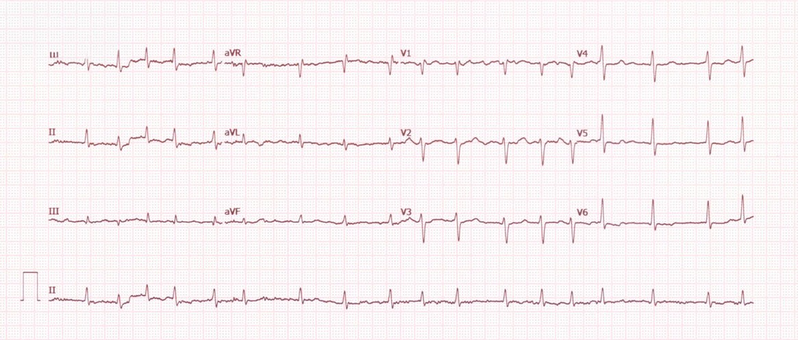 María, de 83 años, con este ECG, está en tratamiento con amlodipino, insulina, un diurético tiazídico y aspirina. ¿Qué cree que le falta?