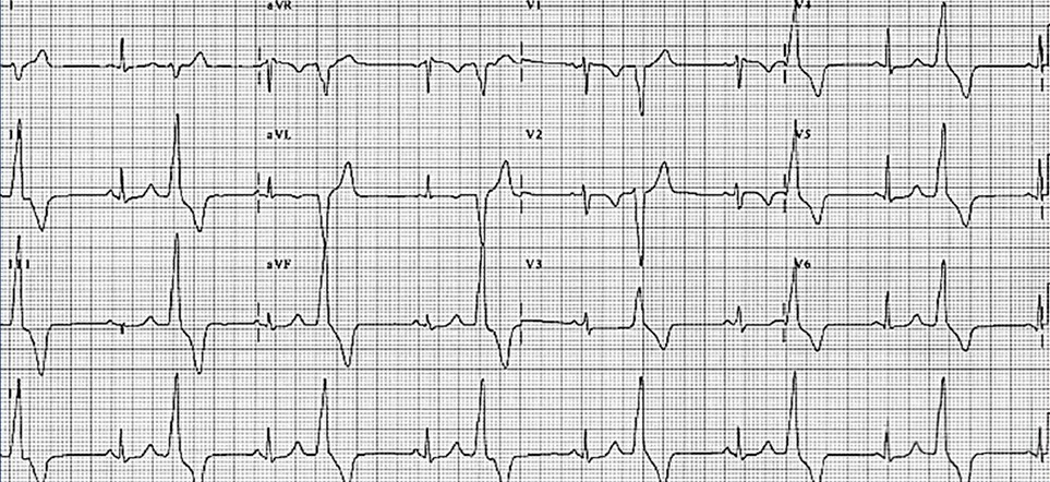 María se queja de que, desde que le prescribieron la última pastilla, se encuentra asténica, inapetente, y ve cosas raras. A la vista del ECG, ¿qué cree que contiene la pastilla?