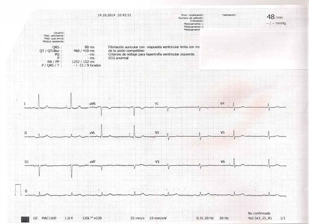 La paciente a la que pertenece este ECG va a ser intervenida quirúrgicamente, y los anestesistas la envían al cardiólogo al haber detectado fibrilación auricular, según se aprecia en la interpretación automática del aparato. Dos años antes esta paciente,