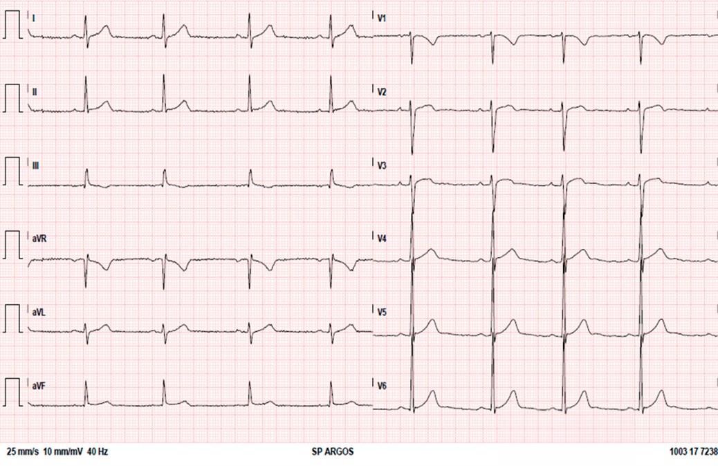 El siguiente ECG corresponde a un varón joven deportista de 25 años. ¿Cuál es su interpretación?