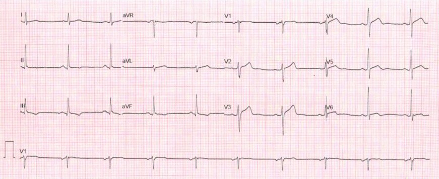 Este ECG, tomado en reposo, pertenece a un paciente de 65 años, hipertenso e hipercolesterolémico, que se queja de dolor torácico atípico desde hace tiempo. ¿Qué le parece?
