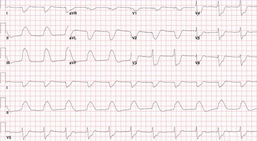 ECG de un paciente recuperado de una parada cardíaca ¿Qué le parece?