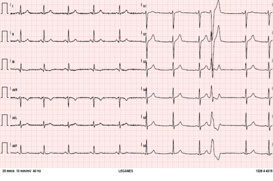 Juan, de 34 años, trabajador de la construcción, se ha hecho el siguiente ECG en un reconocimiento laboral. ¿Qué le parece?
