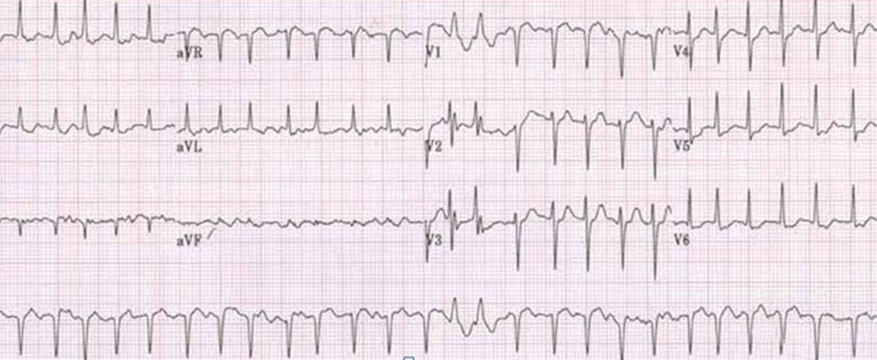 Juana, de 80 años, tiene antecedentes de HTA y diabetes que trata con fármacos. Hace una semana tuvo que acudir a Urgencias por malestar, disnea y mareo. Allí le hicieron el siguiente ECG. ¿Que le parece?