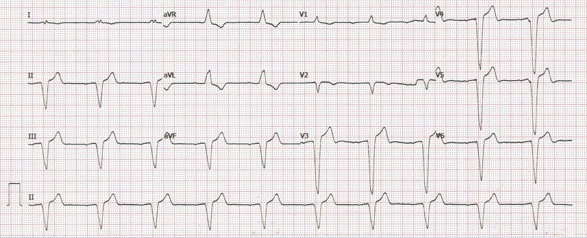 ¿Qué le parece este ECG?