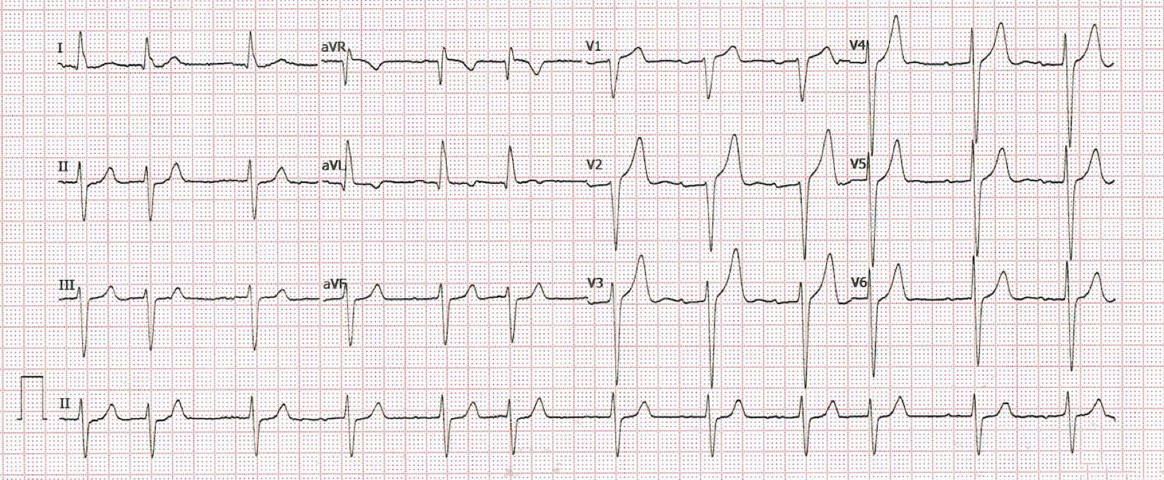 ¿Qué ritmo le parece que presenta el siguiente ECG?