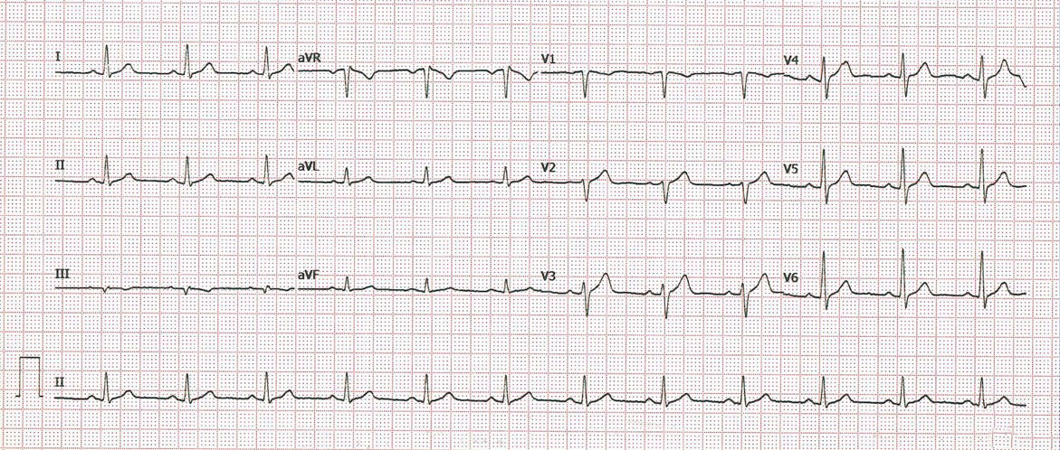 Tomás se ha hecho un ECG y está muy asustado porque le han dicho que tuvo un infarto. ¿Qué le parece?