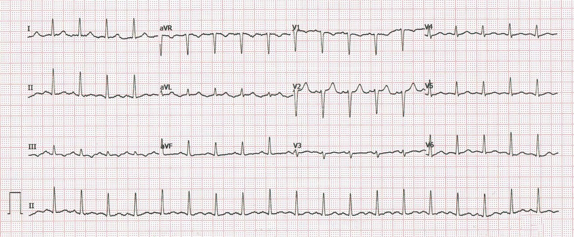 El endocrinólogo nos remite a Virginia, a la que está tratando por hipertiroidismo, porque su ECG no le gusta nada. ¿Qué puede decirle?