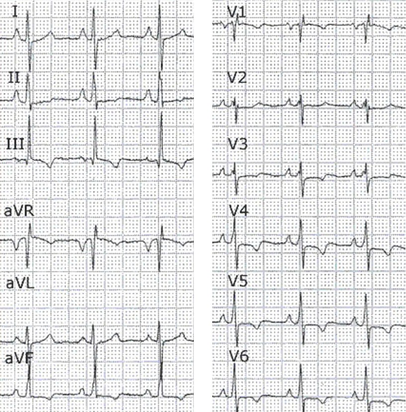 ¿Cuál cree que es la enfermedad predominante del paciente poseedor de este ECG?
