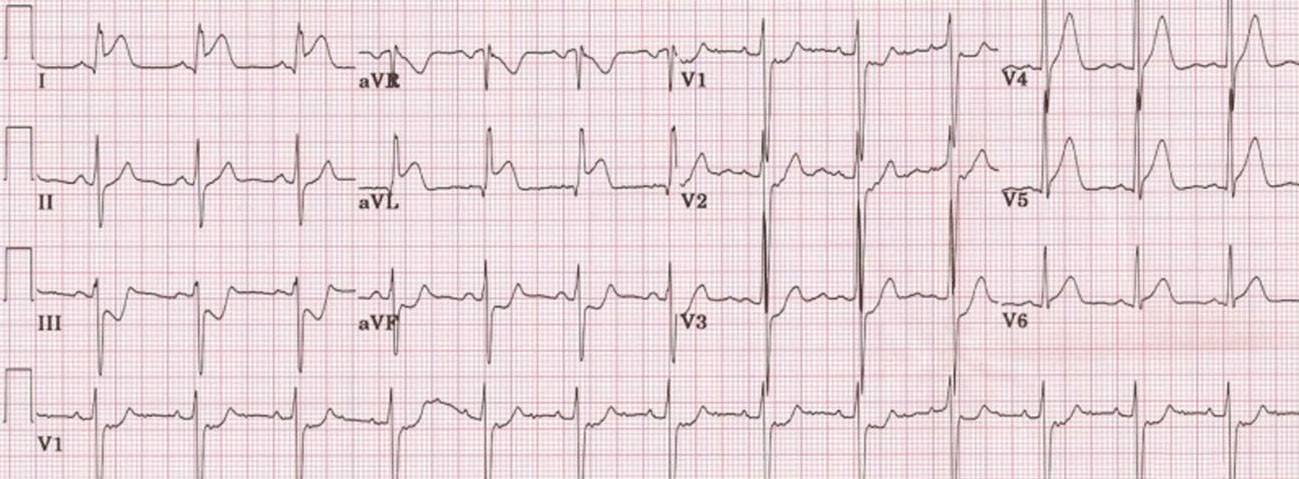 El paciente con este ECG requiere...