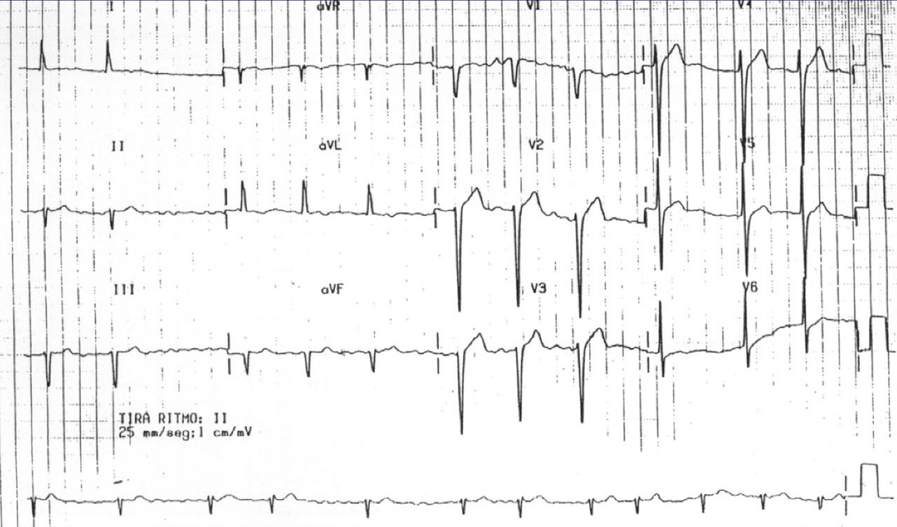 El paciente del siguiente ECG tiene dos problemas ¿se atreve a decir cuáles?